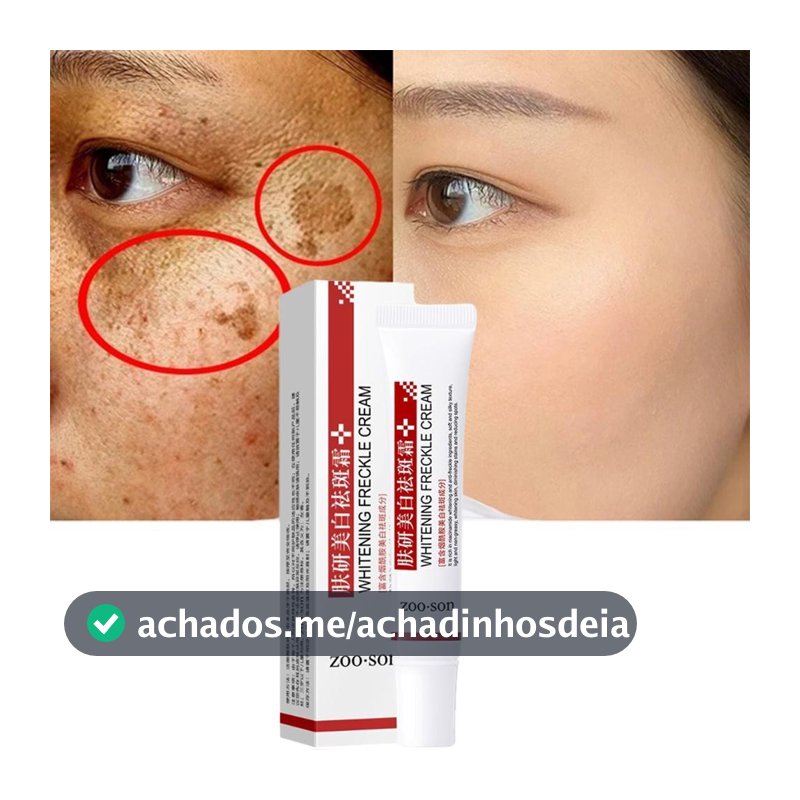 Creme Clareador Para Remover Melasma/Manchas Escuras/Melã/Brilho