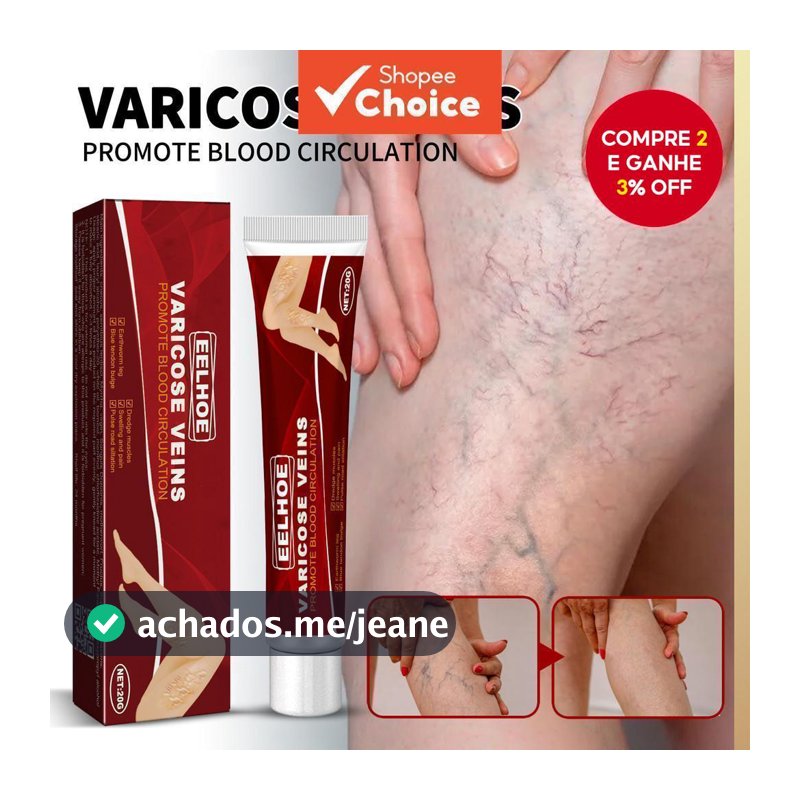 Creme Removedor de Varizes Eelhoe - Eficaz para Cuidados com as Veias das Pernas, Original Earthworm 【Escolha】