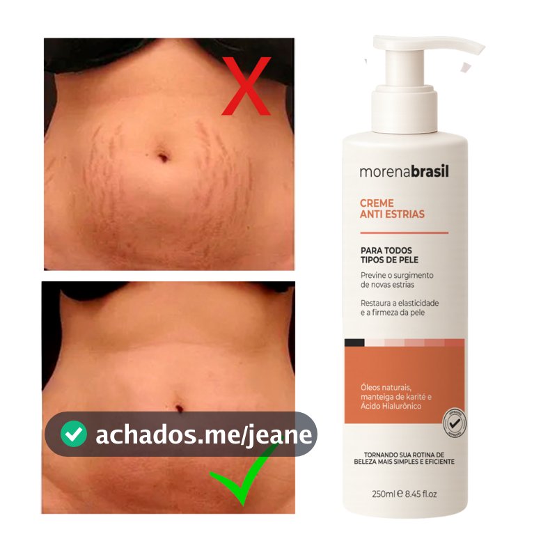 Creme Anti-Estrias - Diga Adeus às Estrias! Previne Novas Estrias & Reforça a Elasticidade Da Pele