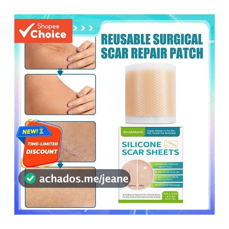 Adesivo De Cicatriz De Silicone West & Mês 4  150 Cm Desbota Todos Os Tipos De Cicatrizes Beleza Suave Para Cuidados Co