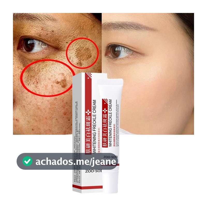 Creme Clareador Para Remover Melasma/Manchas Escuras/Melã/Brilho