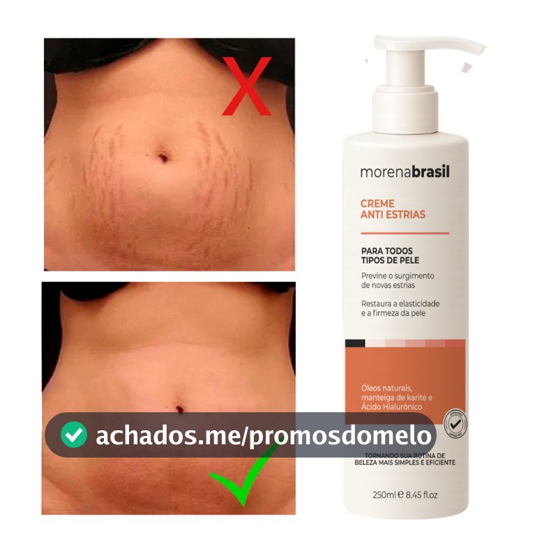 Creme Anti-Estrias - Diga Adeus às Estrias! Previne Novas Estrias & Reforça a Elasticidade Da Pele
