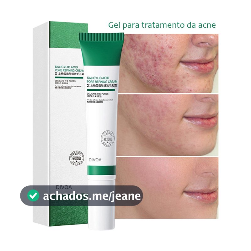 Creme De Ácido Salcyclic 20ml Para Remoção De Poros/Acne & Clareamento/Anti-Ássidade